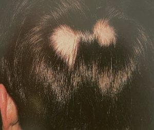 Alopecia areata eller hårtap