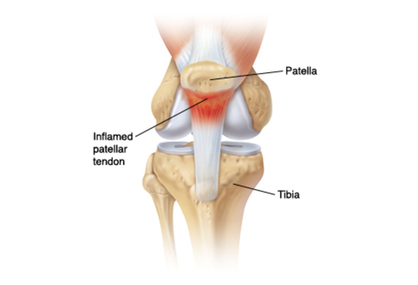Betennelse i patellarsenen (kneskålssenen)
