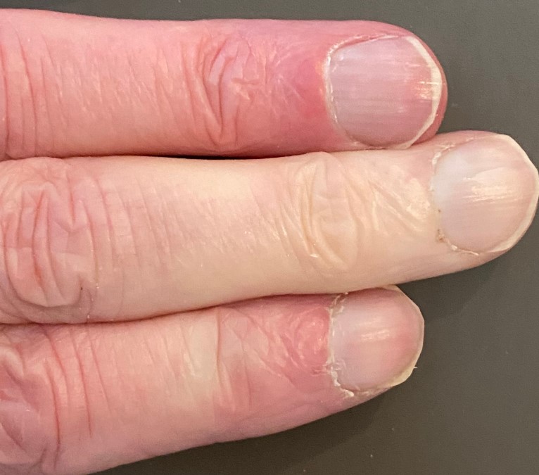 hvite fingertupper - raynauds sykdom