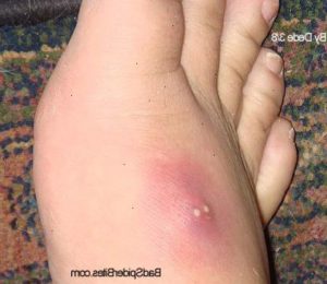 Infeksjon på foten med typiske tegn: Rødme, hevelse, varme og smerte